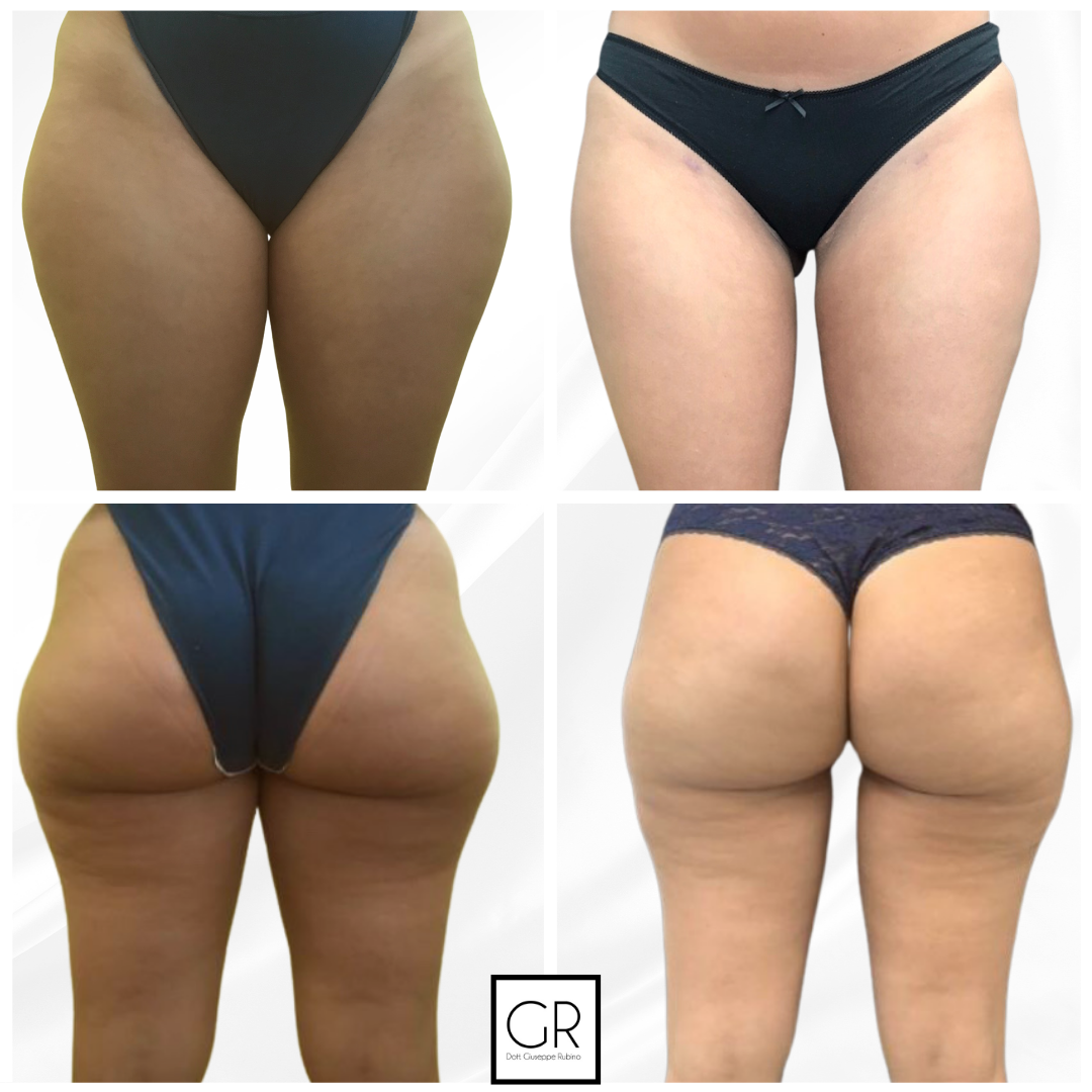 LIPO-DONNA