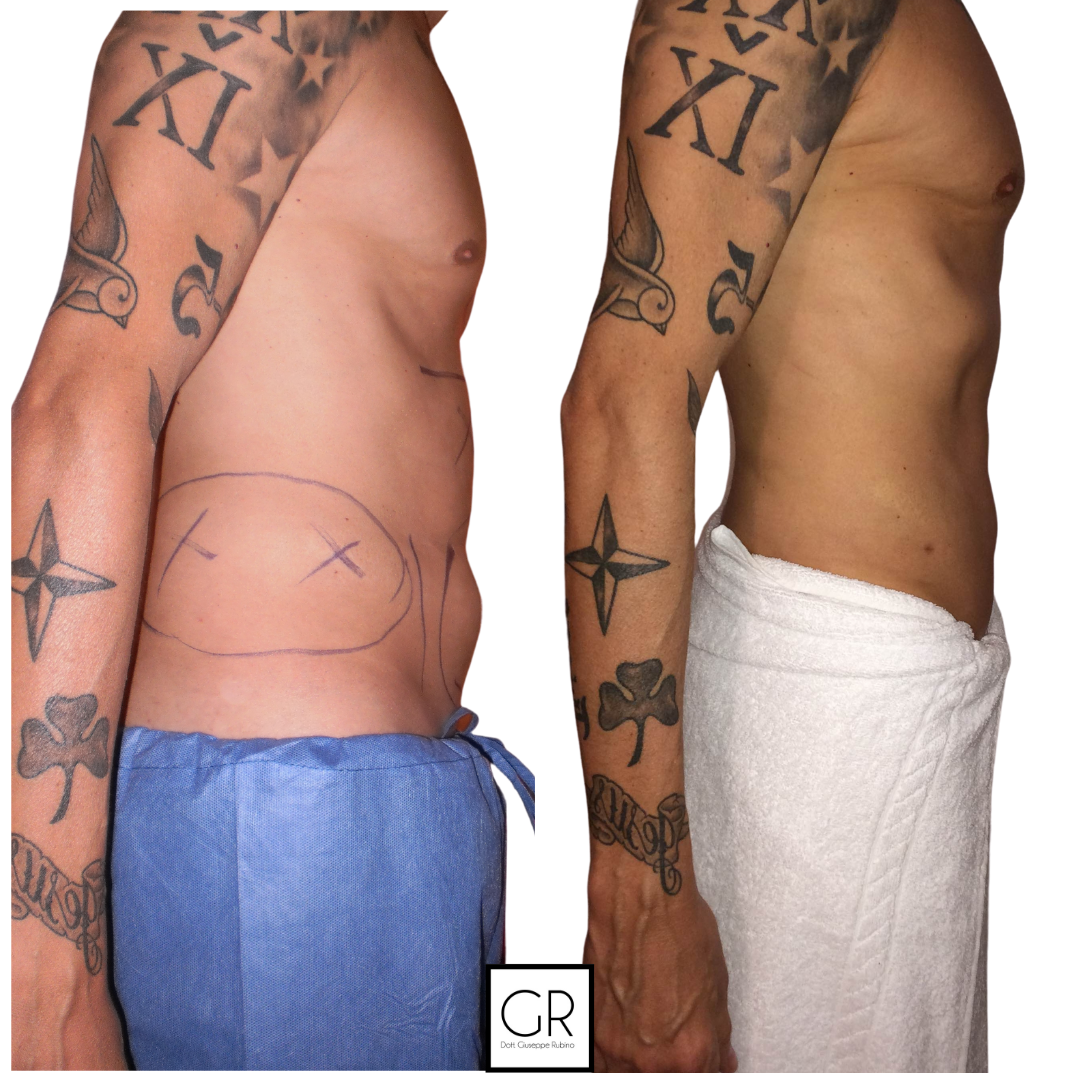 Lipo-vaser-1