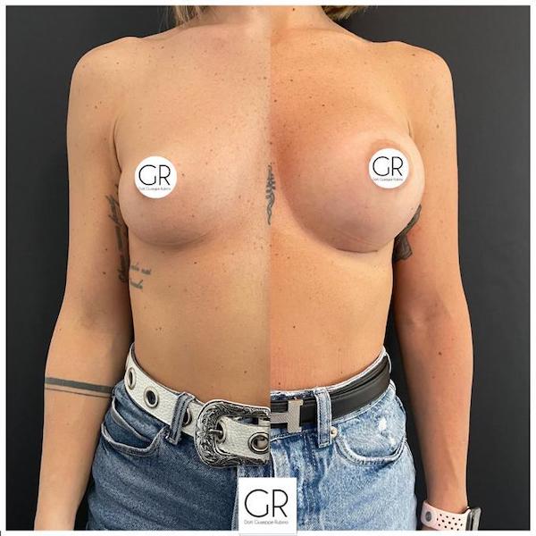 mastoplastica-additiva-1