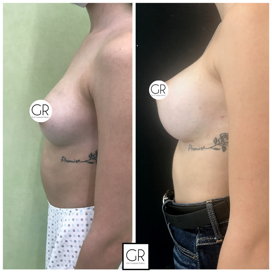 mastoplastica-additiva-10