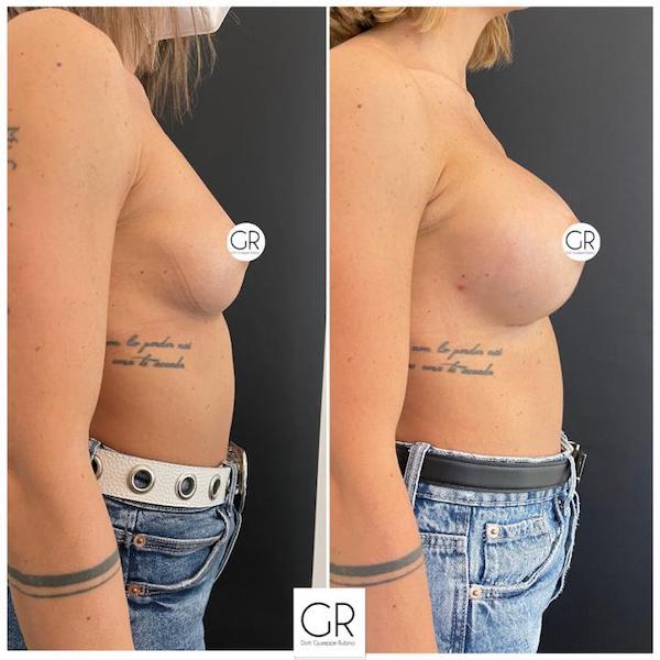 mastoplastica-additiva-2