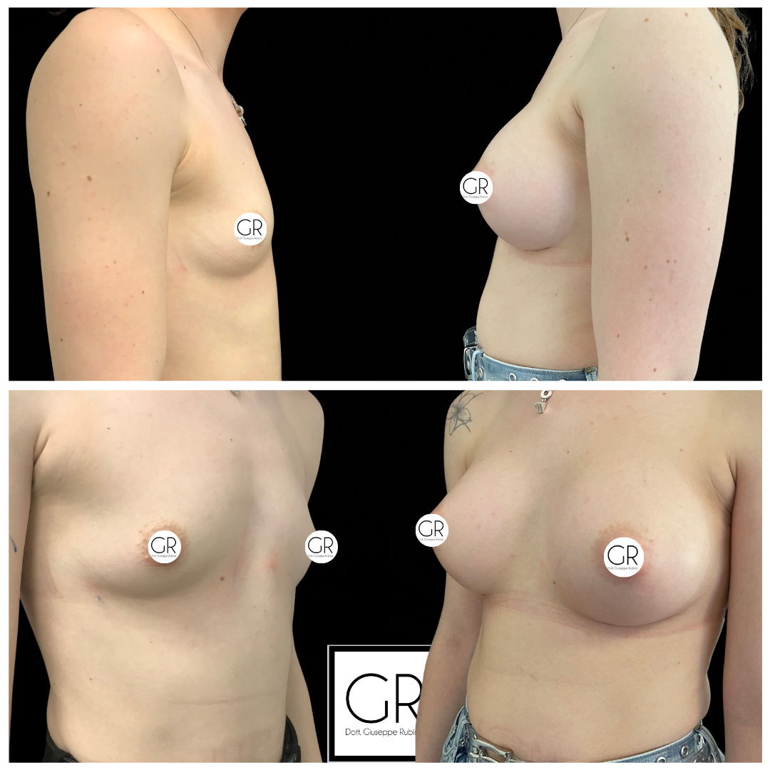 mastoplastica-additiva-5