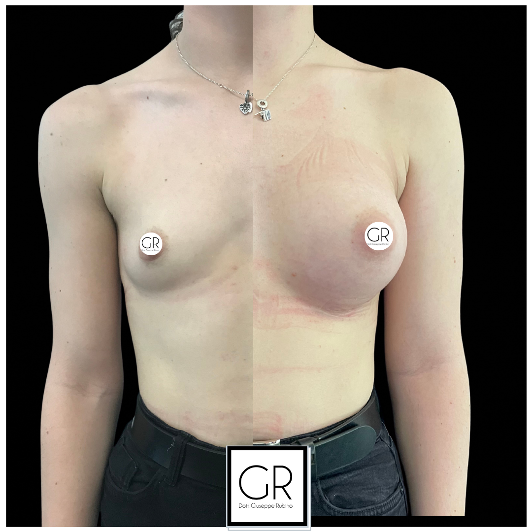 mastoplastica-additiva-6