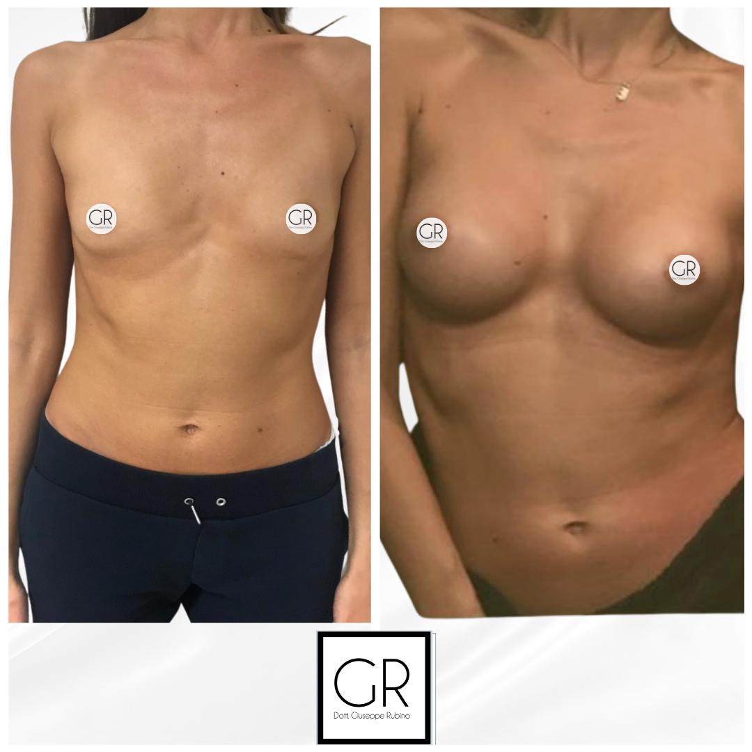 mastoplastica-additiva-7