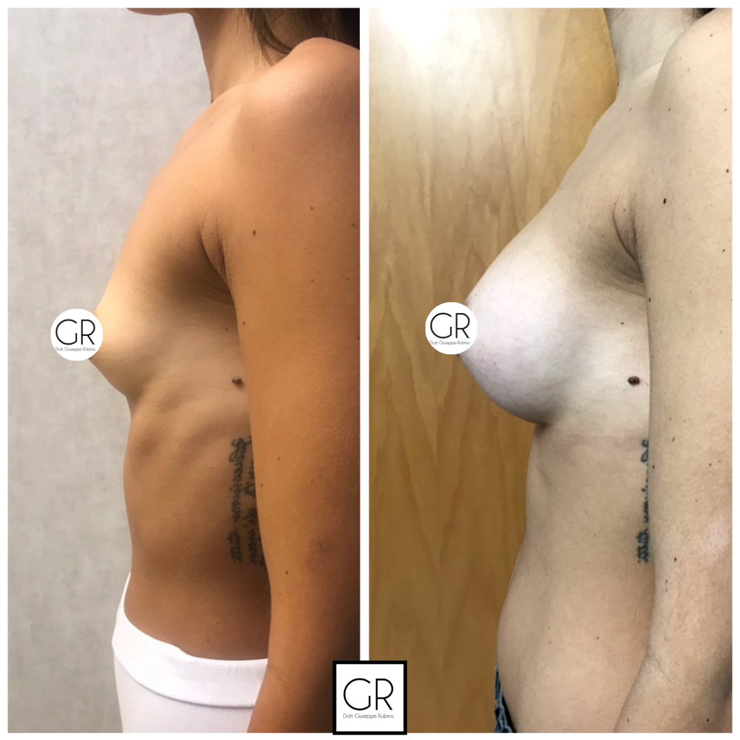 mastoplastica-additiva-8