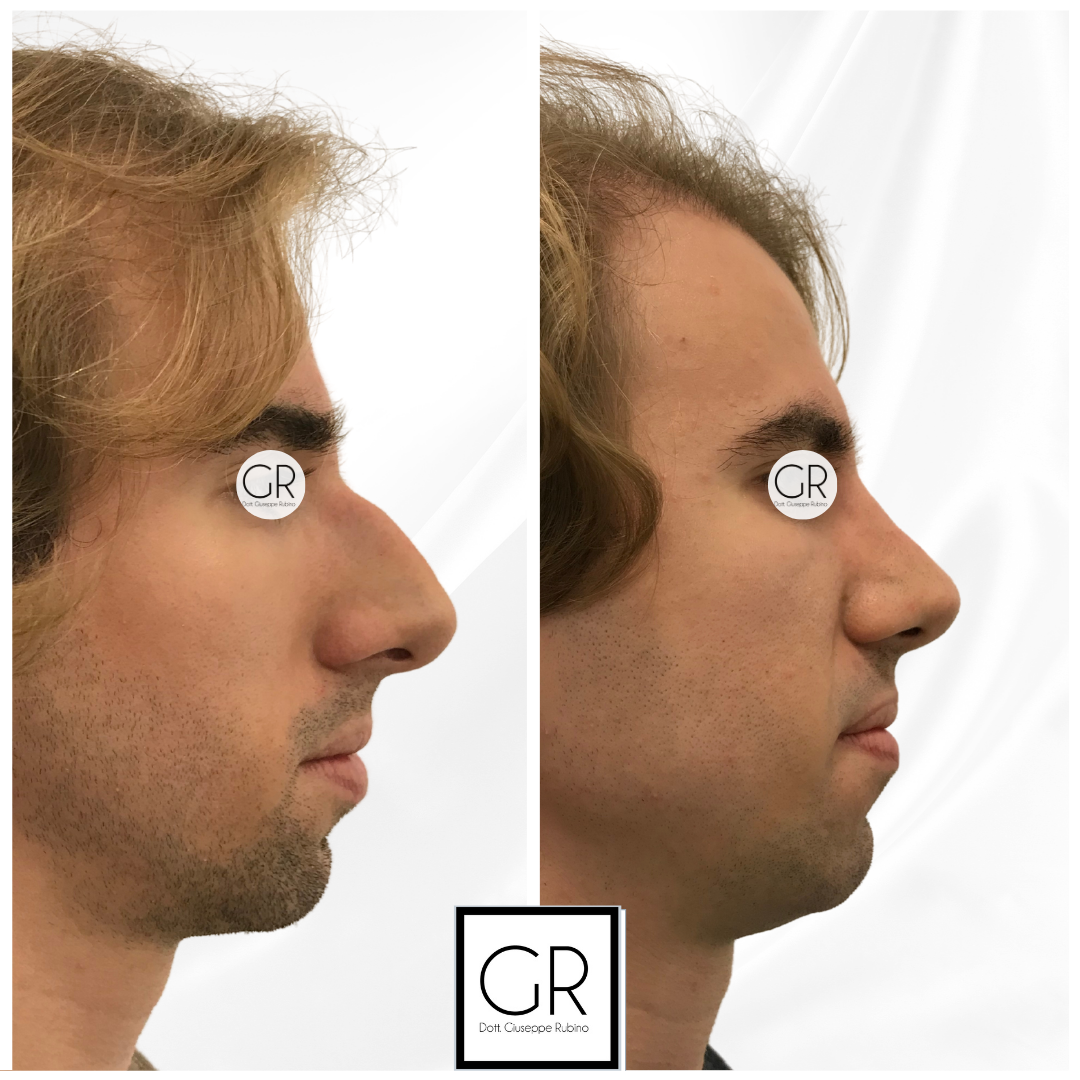 rinoplastica-5